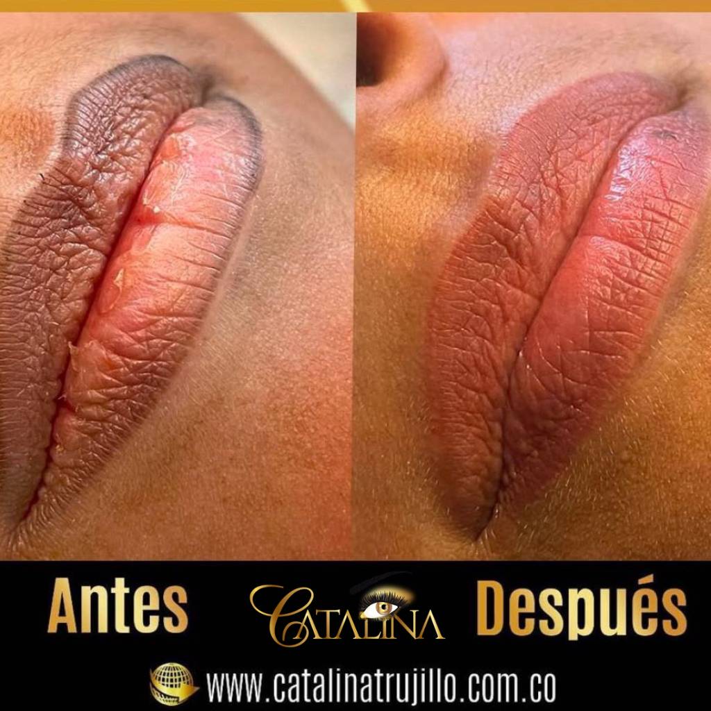 Neutralización de labios